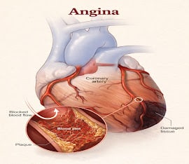 Angina Blocked Coronary Artery