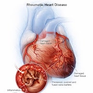 Rheumatic Heart Disease In Pregnancy Mitral Valve