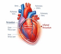 Acute Pericarditis Heart Anatomy Diagram
