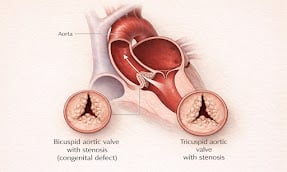Aortic Stenosis Narrowed Valve Diagram