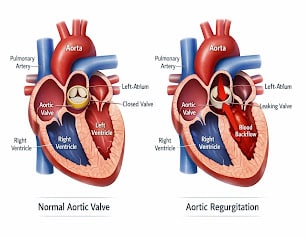 Aortic Valve Normal Vs Regurgitation Diagram