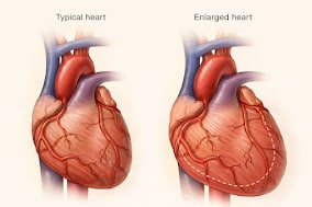 Dilated Cardiomyopathy Enlarged Heart Vs Normal Heart