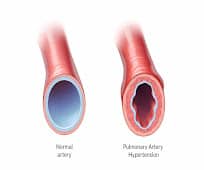 Normal Artery Vs Pulmonary Hypertension Artery