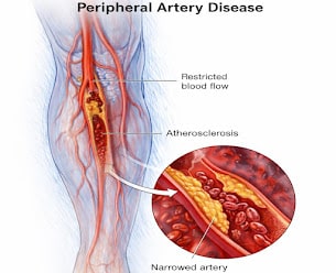 Peripheral Artery Disease Leg Artery Blockage Copy