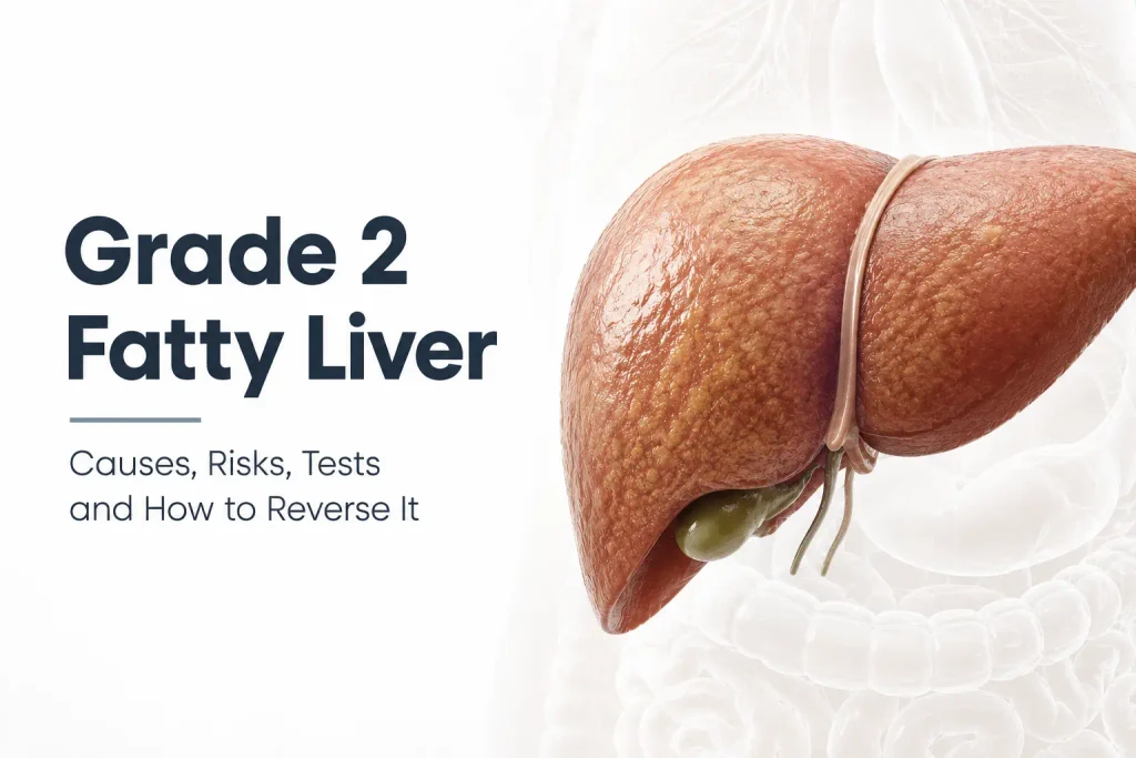 Grade 2 fatty liver illustration showing moderate fat in the liver