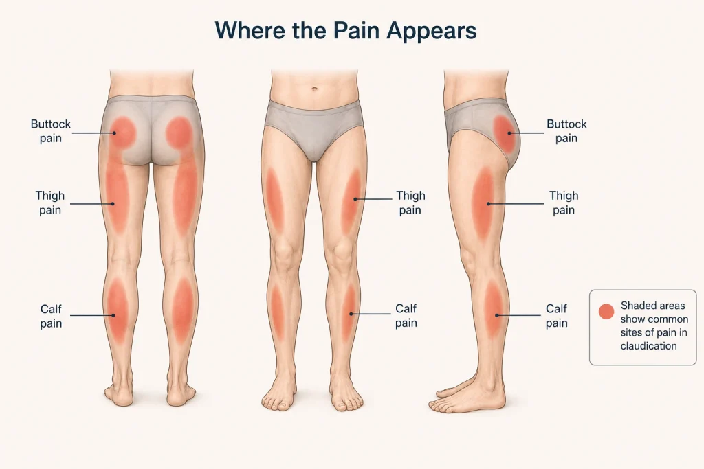 claudication leg pain locations